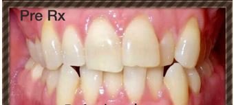 Brace-tretment Brace-tretment