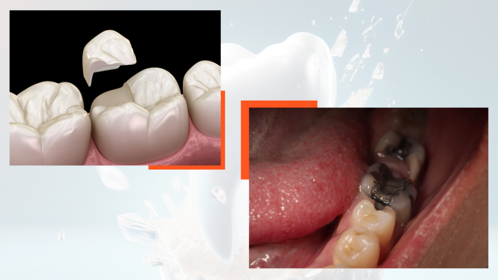 Tooth Filling Treatment Clinic in Newtown