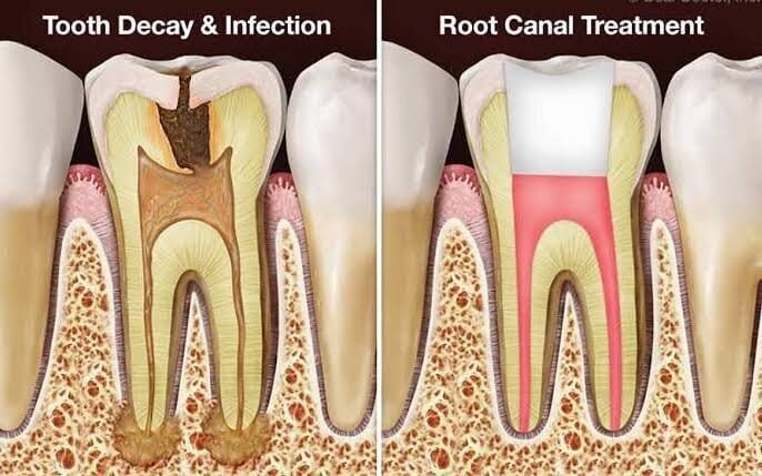 Painless root canal treatment