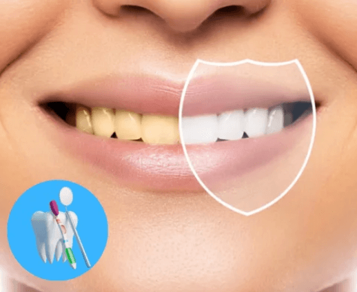 Teeth whitening treatment